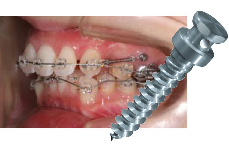 歯科矯正用アンカースクリューを使用した矯正歯科治療2